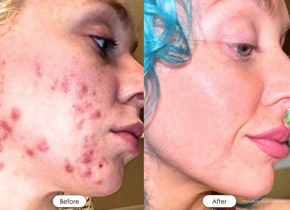 LightAura Flex LED face mask light therapy before and after results showing reduced acne